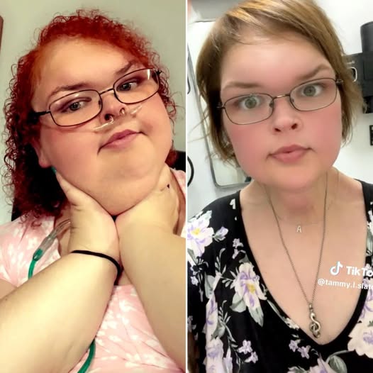 1000 Lb Sisters: Tammy Slaton’s Skin Removal Surgery Was A SUCCESS — Here Are Before & After Pictures!