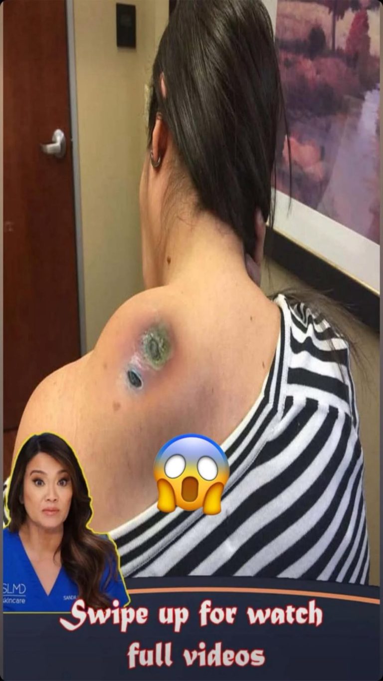 What the Acne on 5 Body Parts Is Trying to Tell You About Your Lifestyle Habits…