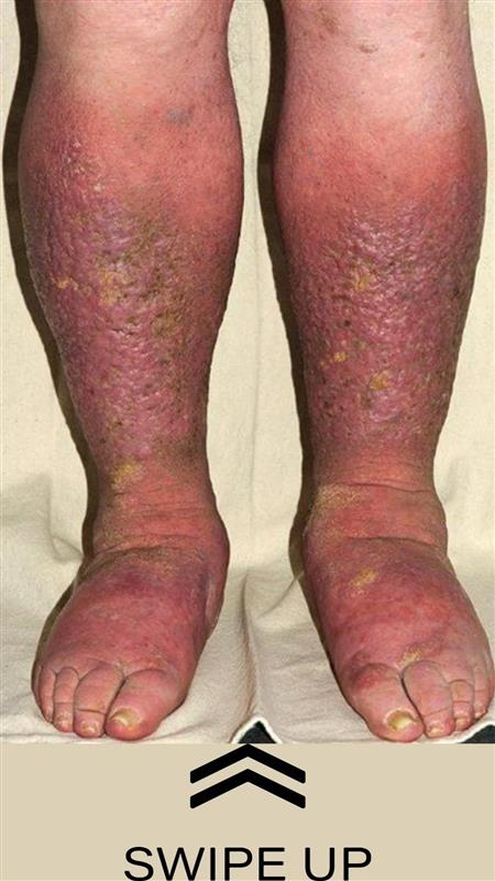 How Your Feet Could Be Signaling Heart Problems and Clogged Arteries