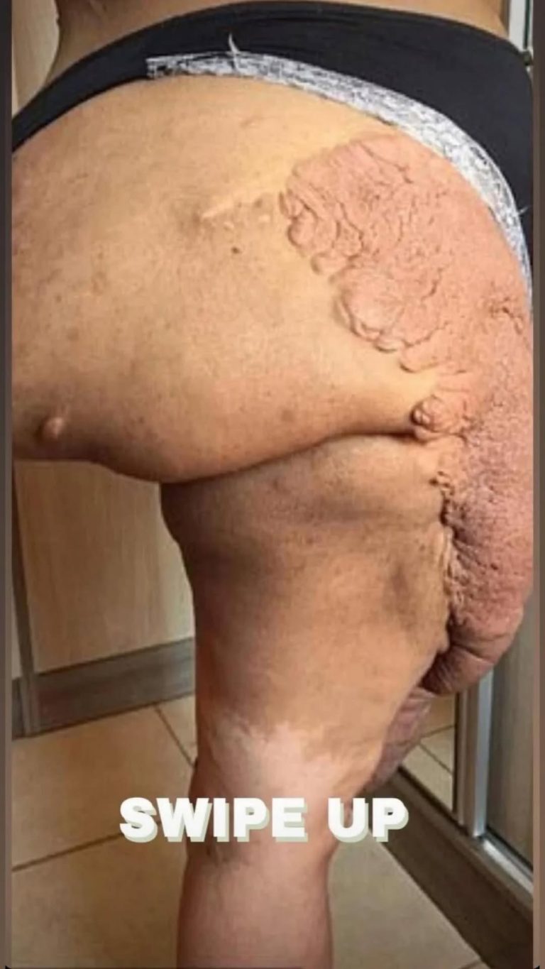 Neurofibroma: Understanding Its Origins, Signs, and Treatment Options